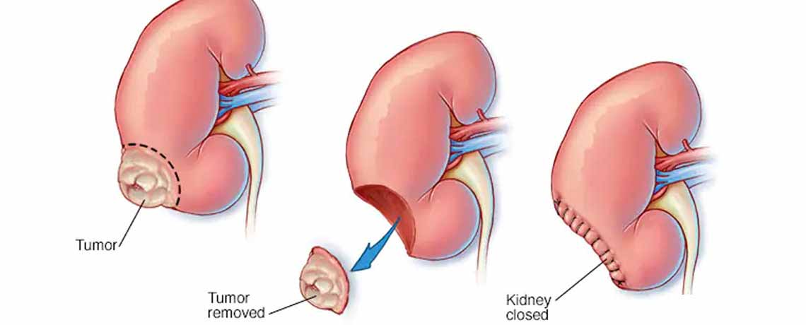 Kidney Cancer