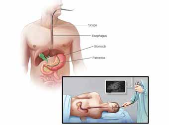 Pancreas Cancer