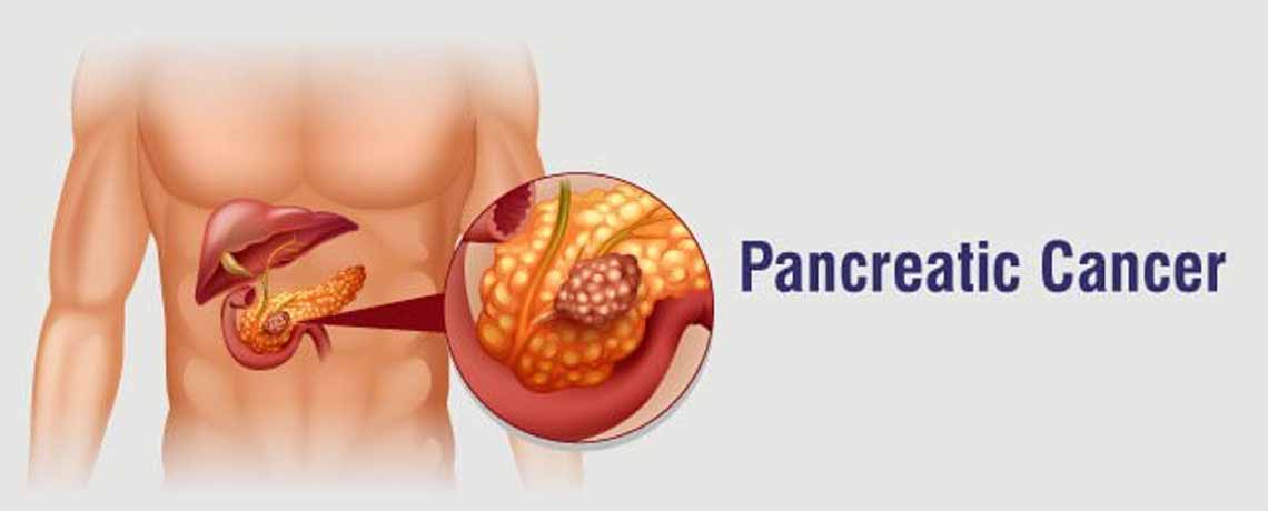 Pancreas Cancer