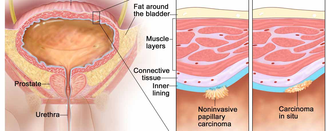 Urinary Bladder Cancer