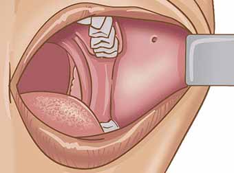 Buccal Mucosa Cancer