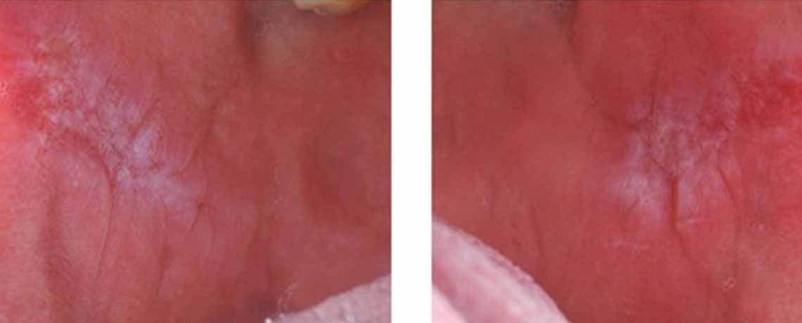 Buccal Mucosa Cancer