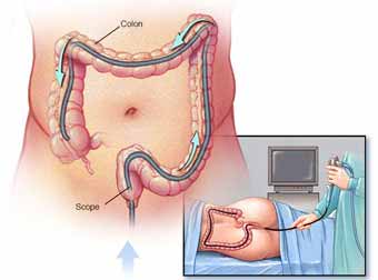 Colon Cancer & Rectal Cancer Treatment