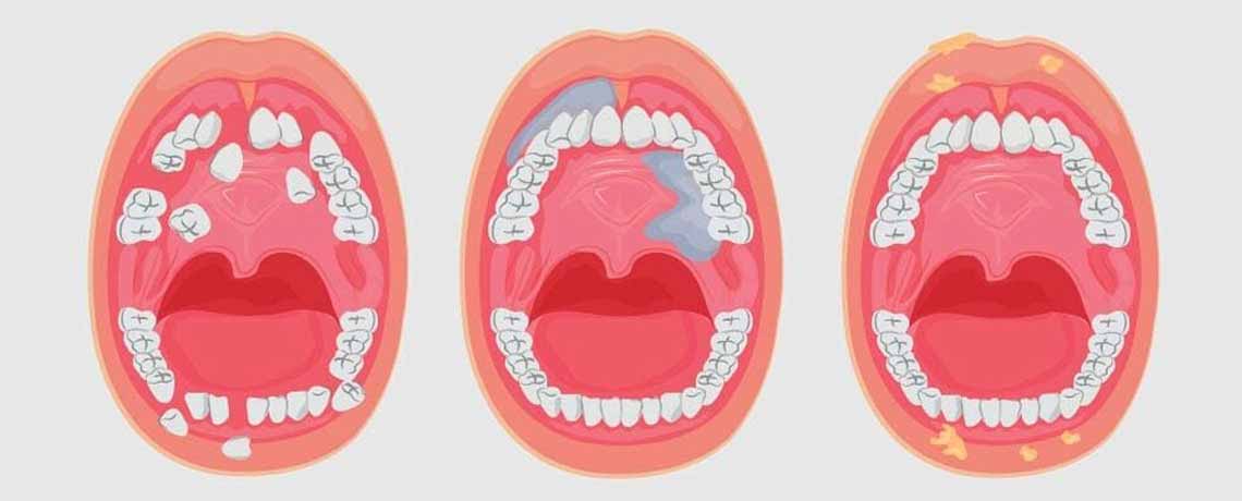 Oral Cavity Cancer