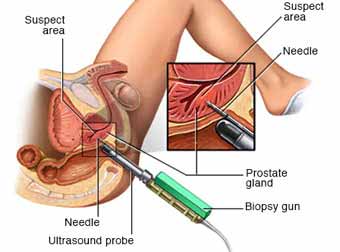 Prostate Cancer Treatment