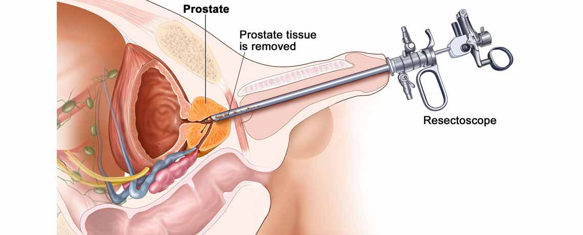 Prostate Cancer Treatment