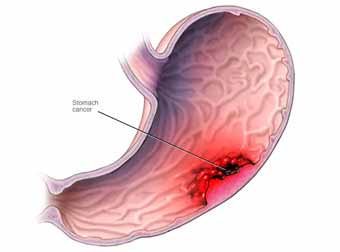 Stomach Cancer