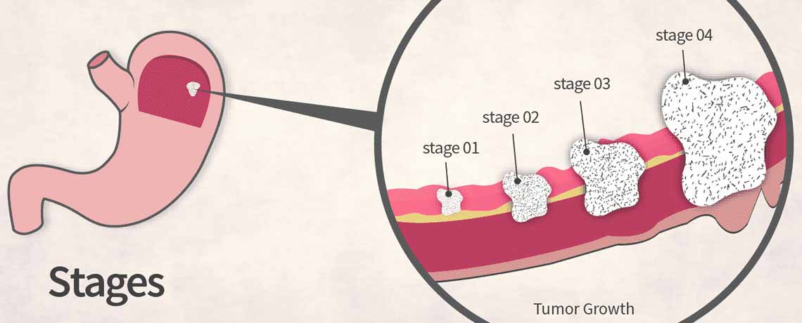 Stomach Cancer