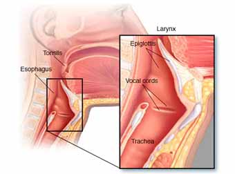 Throat Cancer