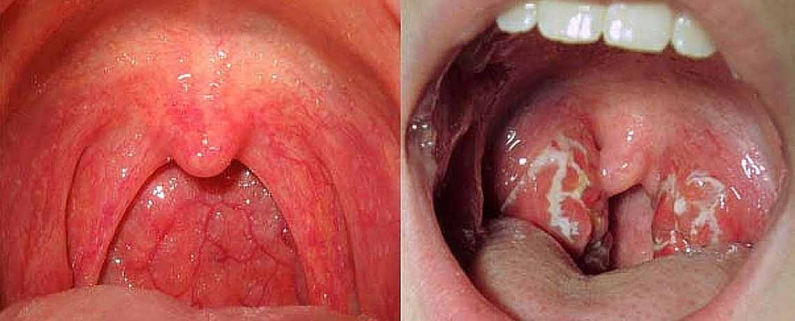 Throat Cancer