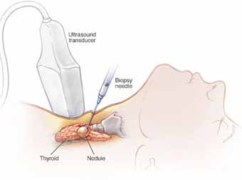 Thyroid Cancer Treatment