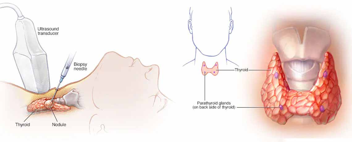 Thyroid Cancer Treatment