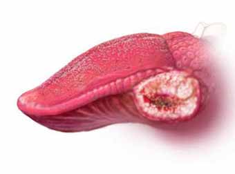 Tongue Cancer