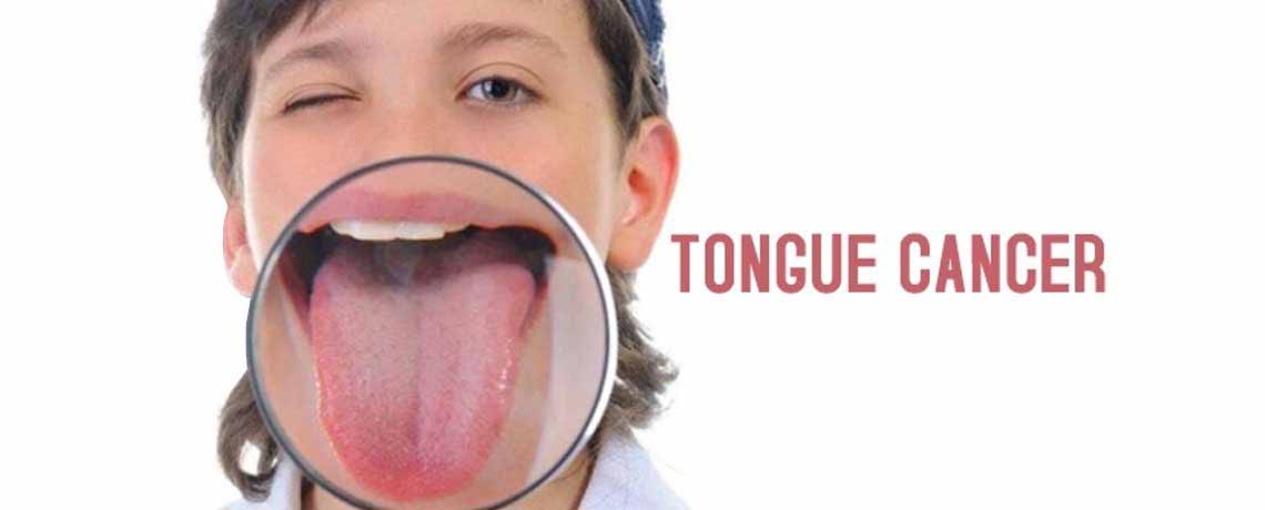 Tongue Cancer